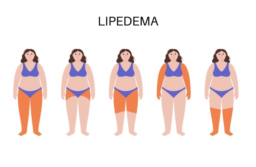 lipedema